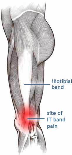 Iliotibial Band (ITB) Syndrome - Back in Action
