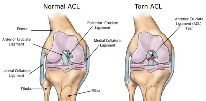 torn acl surgery torn acl surgery