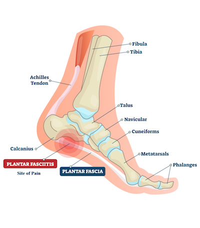 Plantar fasciitis - Back in Action