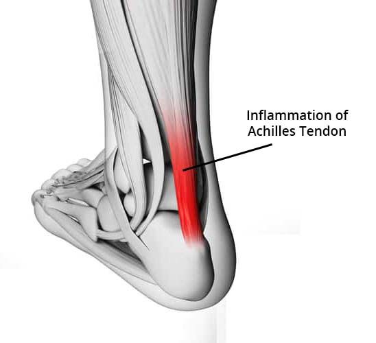 foot pain achilles tendon area