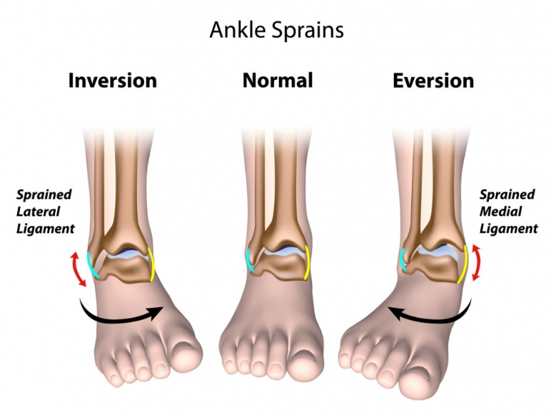 Supination Trauma: Rolling your Ankle