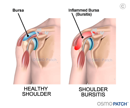 torn bursa shoulder