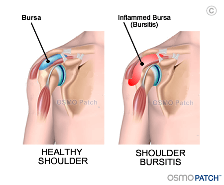 bursa removal shoulder)