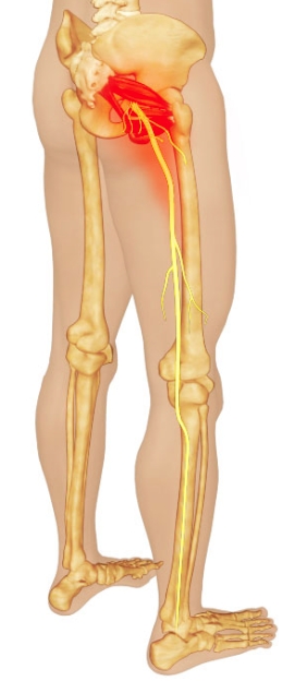 Piriformis Syndrome Image Back In Action