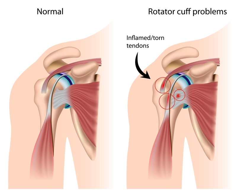 Rotator cuff injury symptoms and best sale treatment