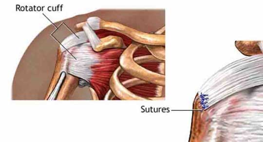 Rotator Cuff Repair - Back in Action