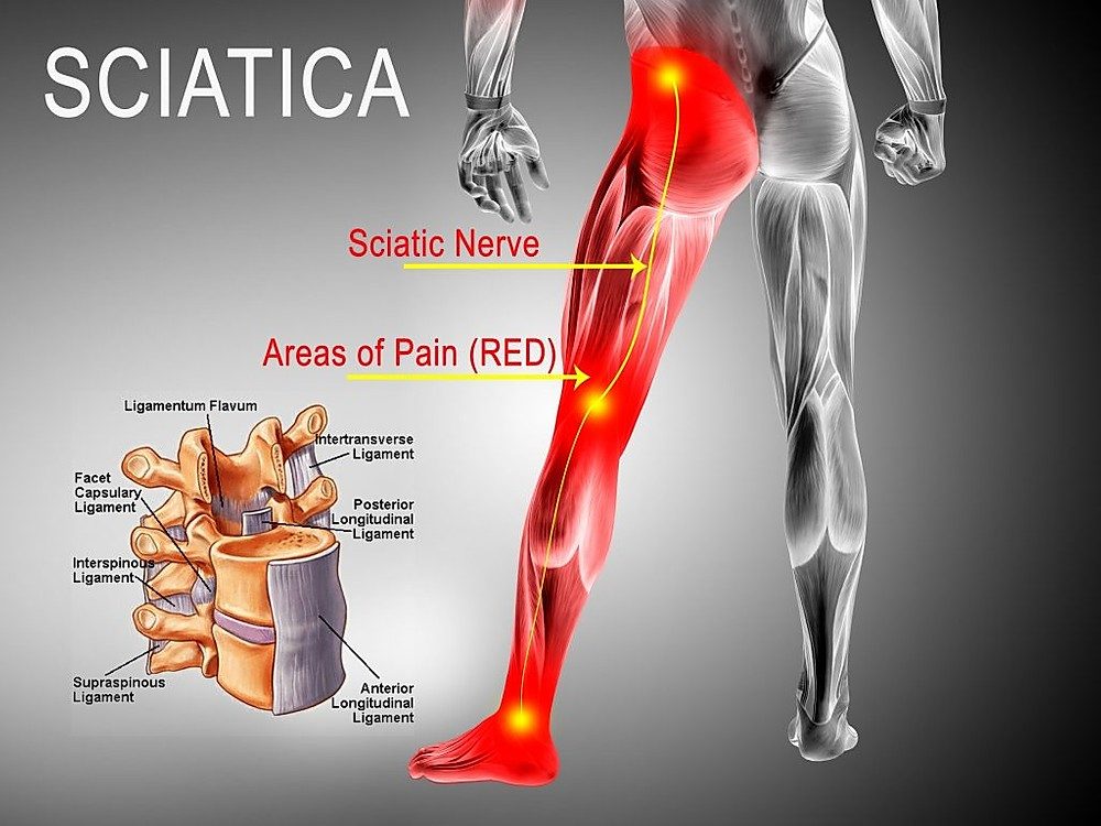 Hip Related Sciatica (Piriformis Syndrome and Deep Gluteal Syndrome): What is it, What are the Symptoms and What Causes It?