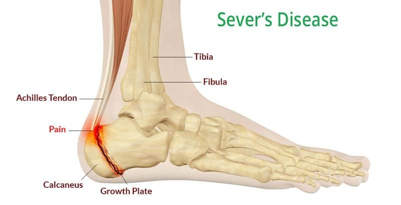 Foot and Ankle Conditions by Area | Side View | Sol Foot & Ankle Centers