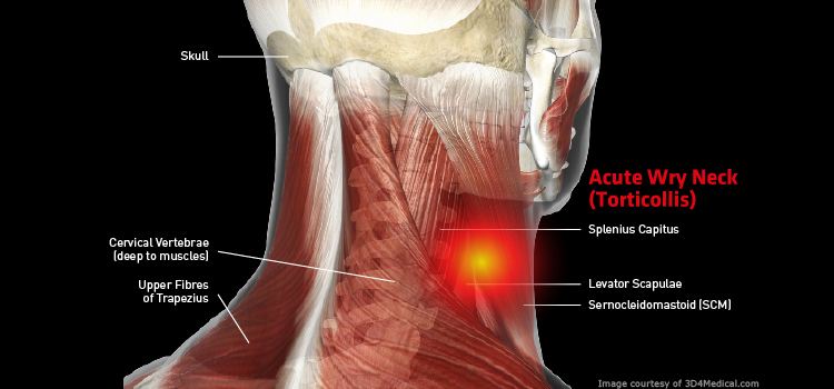 Stiff Neck/Torticollis - Back in Action