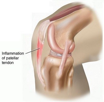 Patella tendon inflammation