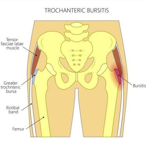hip bursitis
